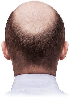 Bald Head PNG Cutout