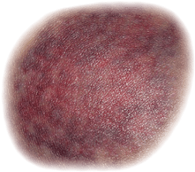 Bruise PNG Cutout