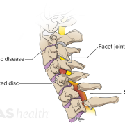 Neck Pain PNG Download Image