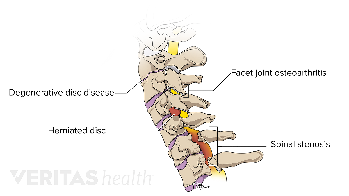 Neck Pain PNG Download Image